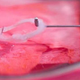 Image for article titled Functioning anal sphincter grown in a petri dish